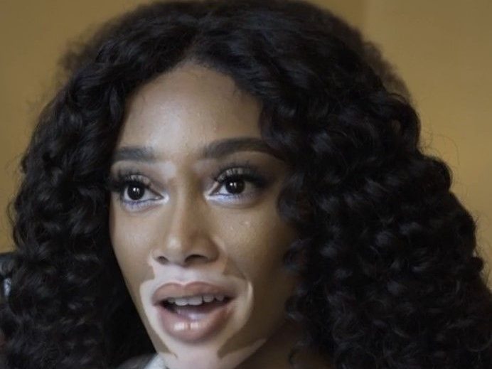 Winnie Harlow